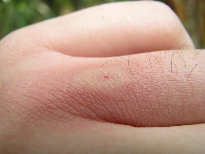 黄蜂蛰人后还能活吗