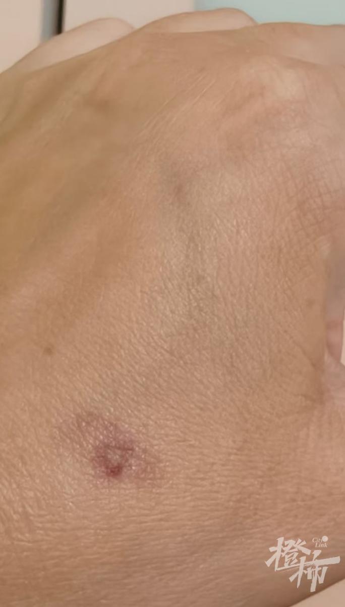 被大黄蜂咬了会怎么样