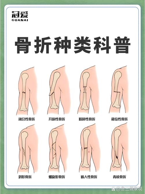 琼斯骨折和基底骨折区别